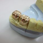 銀歯より金歯