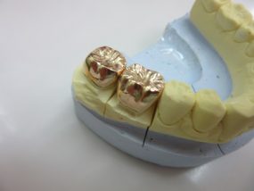 銀歯より金歯